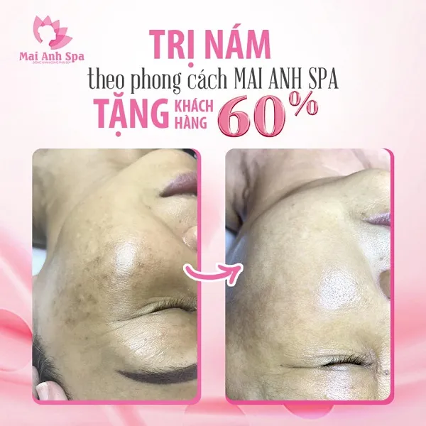 trị nám ở bắc ninh